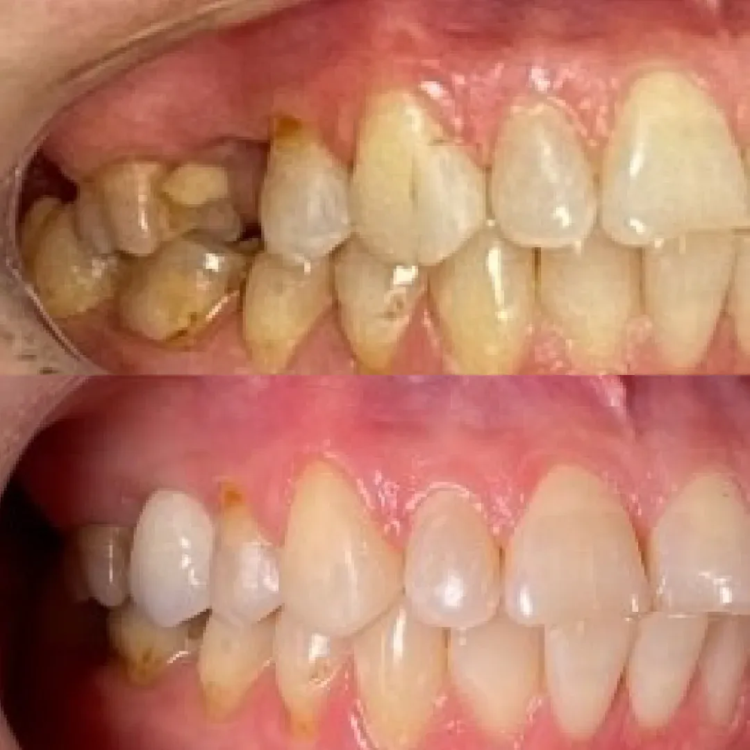 Antes e depois de implante dentário