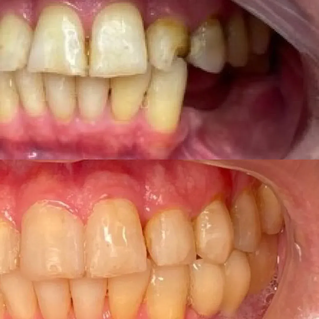 Antes e depois de reabilitação oral