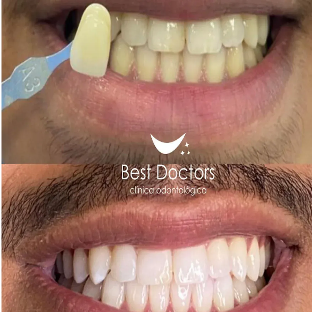 Antes e depois de implante dentário
