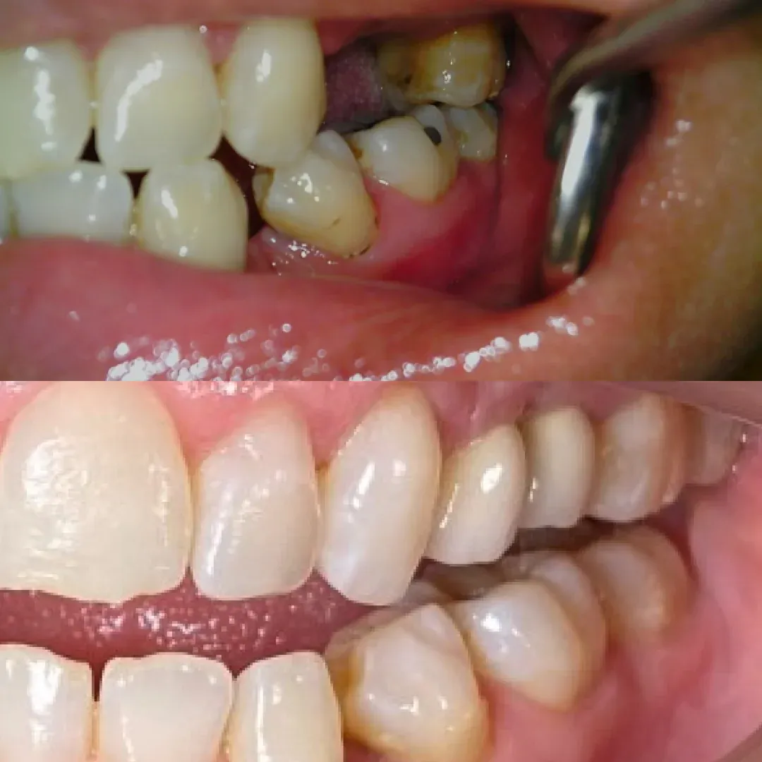 Antes e depois de implante dentário