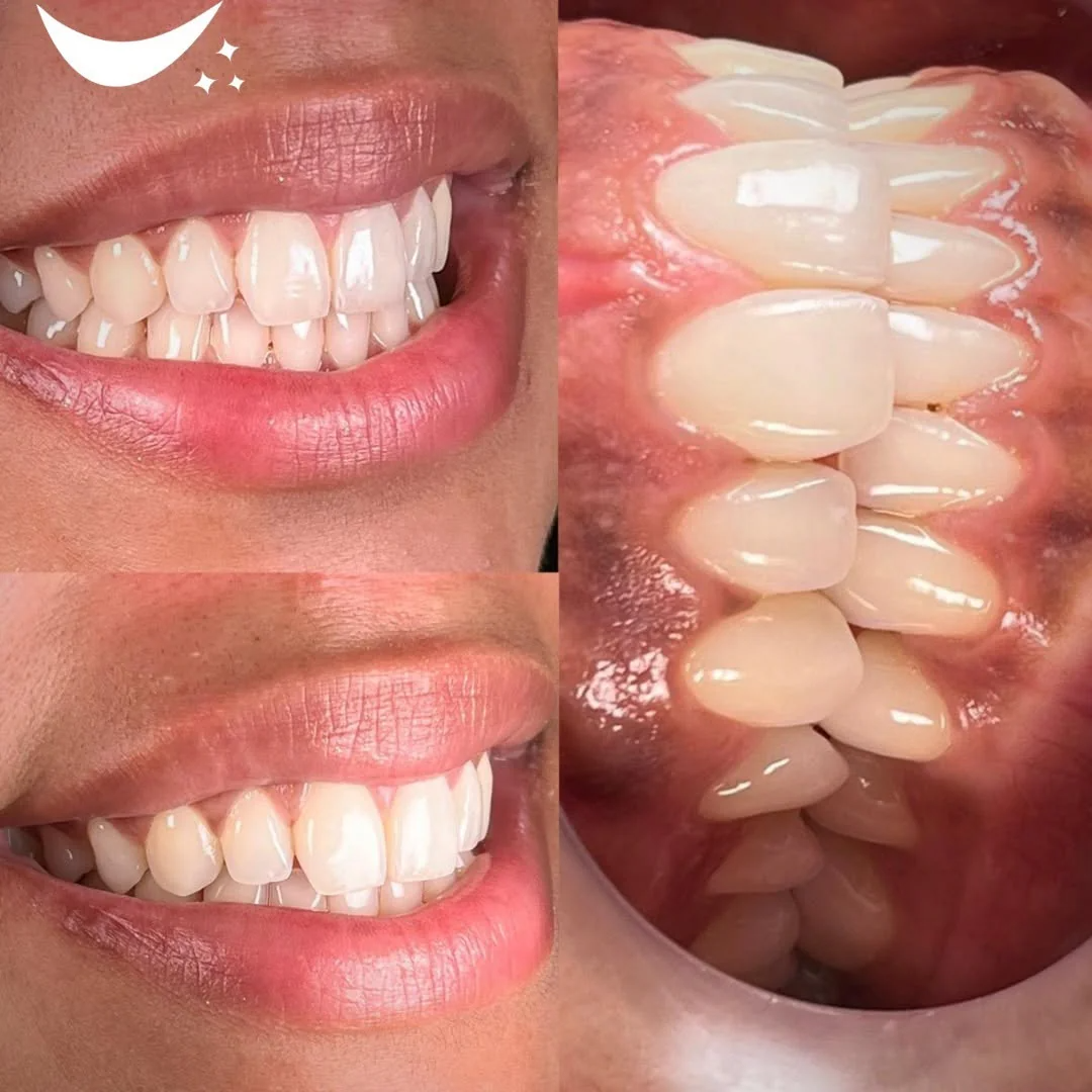 Antes e depois de implante dentário