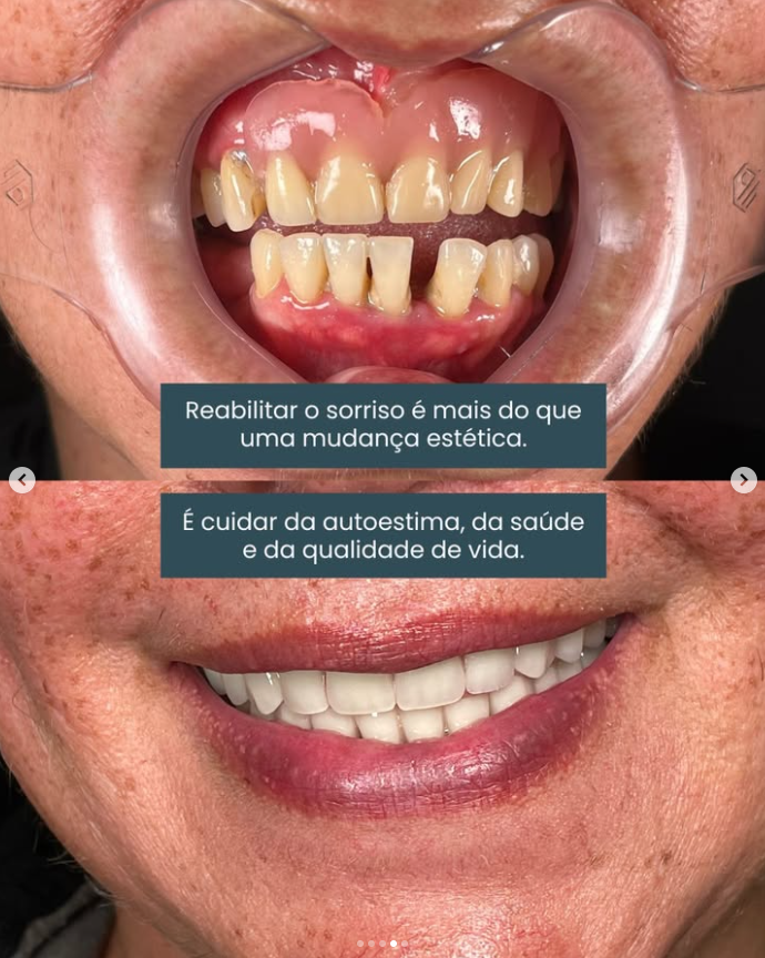 Antes e depois de implante dentário