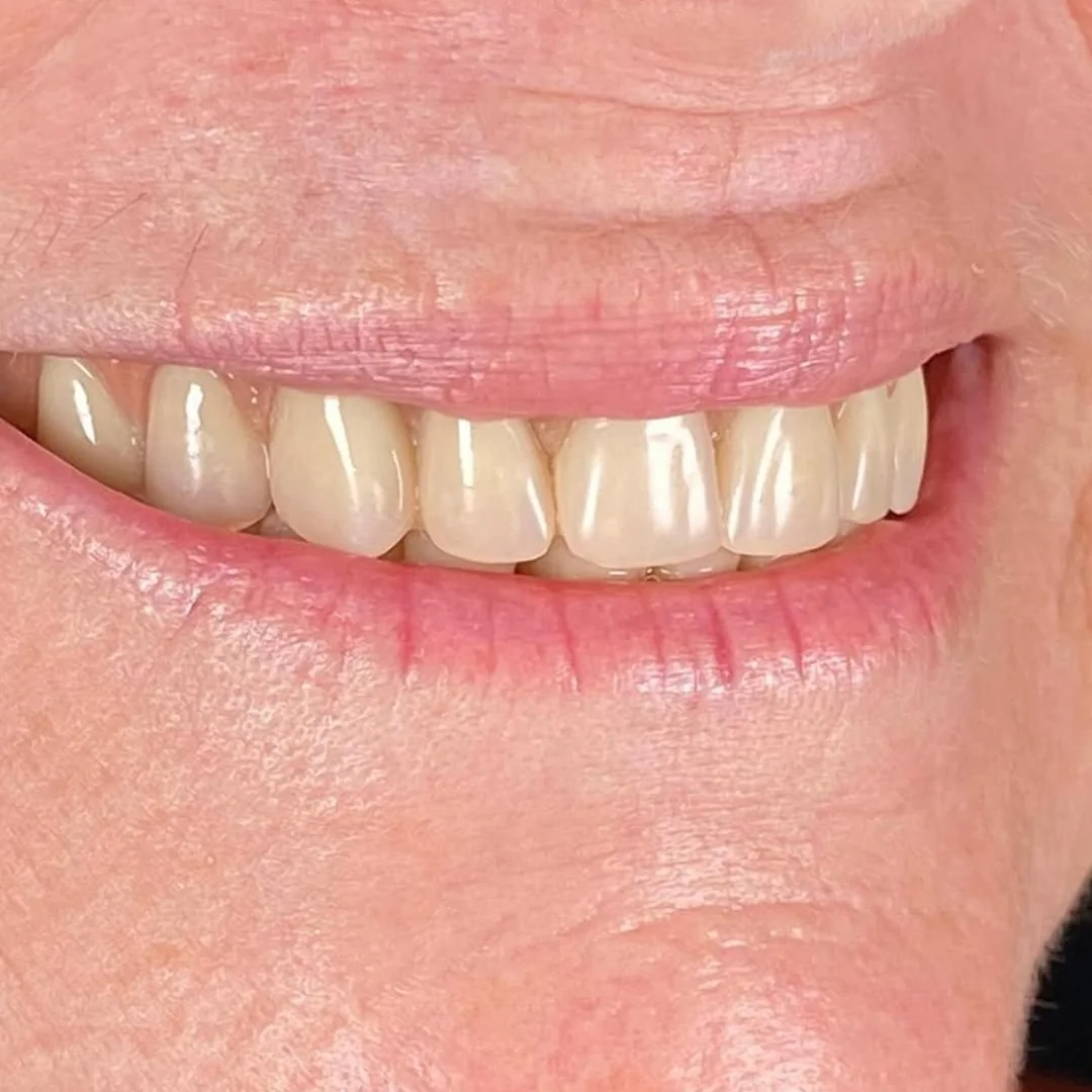 Antes e depois de implante dentário