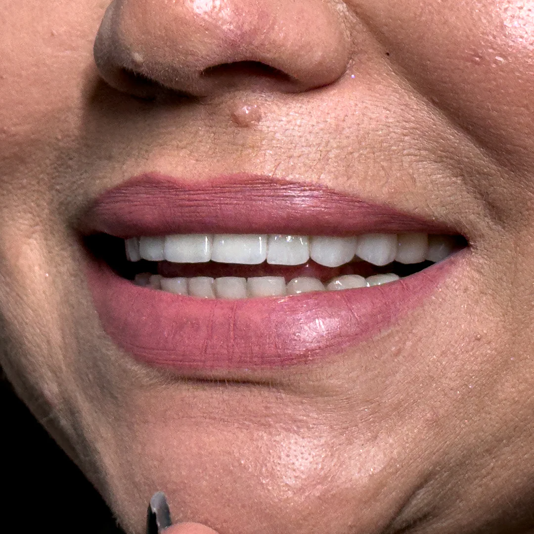 Antes e depois de implante dentário